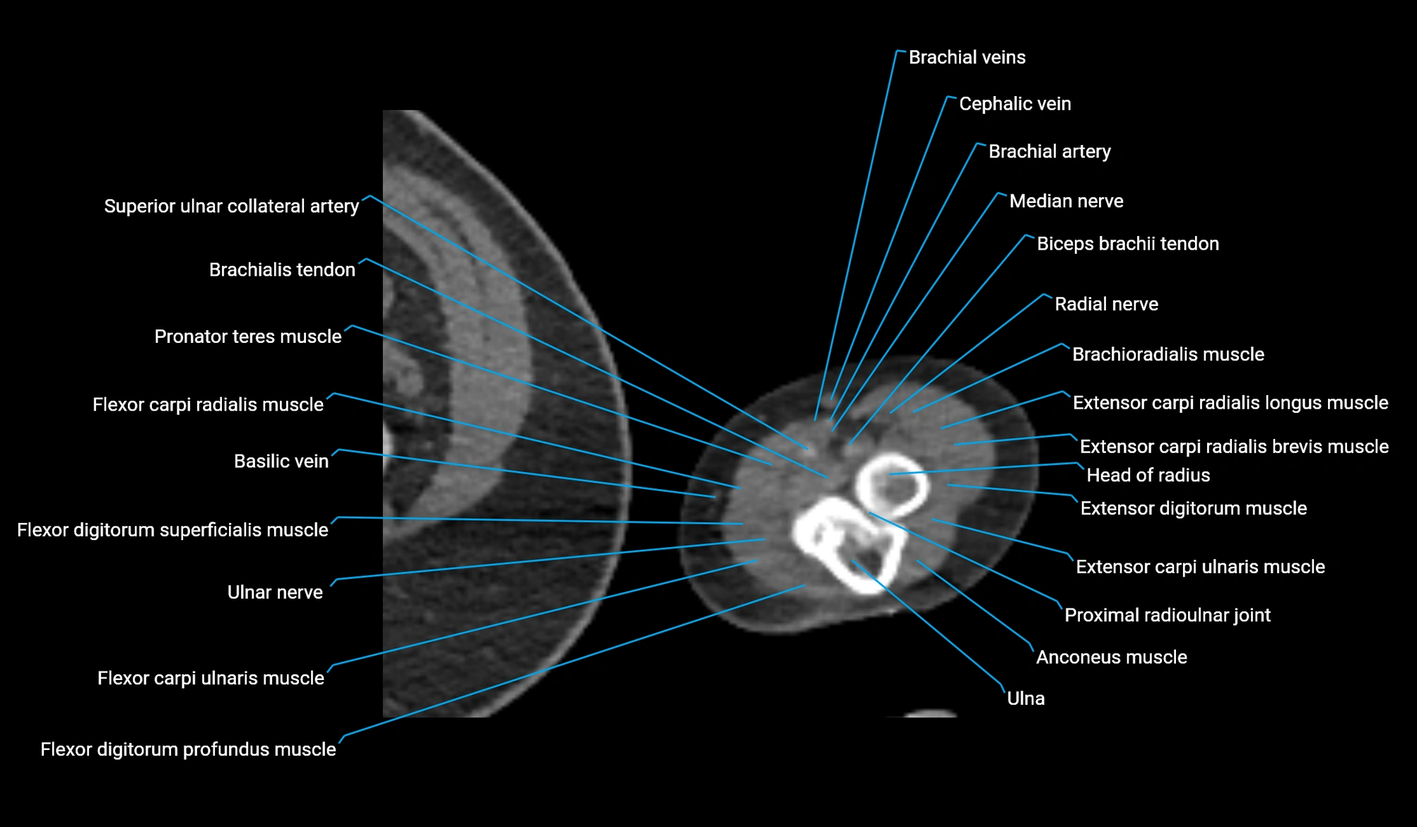 CT upper arm axial  cross sectional anatomy labelled radiology image -00406.webp